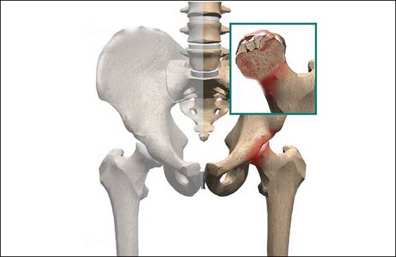 Treatment-for-Avascular-Necrosis-Osteonecrosis