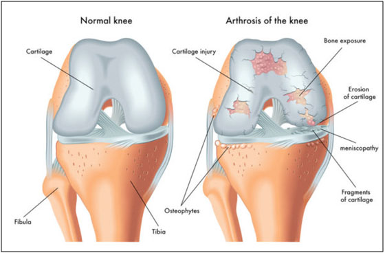 Normal Cartilage vs Damaged Cartilage