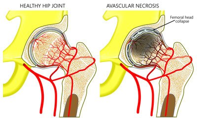 Healthy Joint & Avascular Necrosis (AVN)