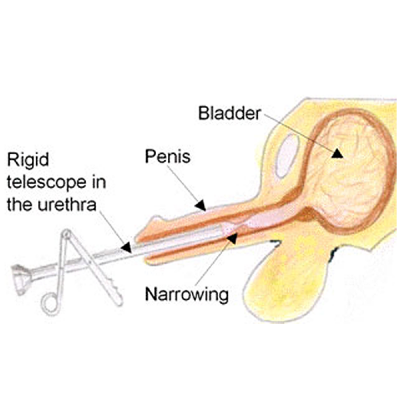 Surgical treatment for urethral stricture