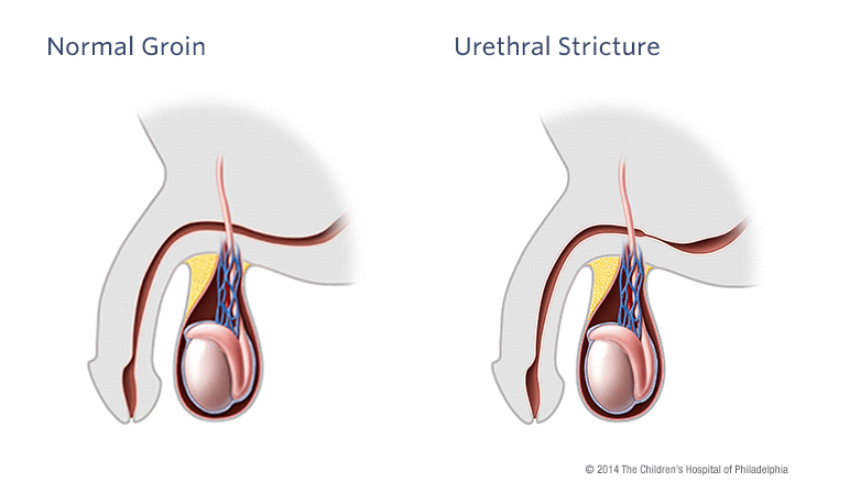 Normal Groin vs Urethral Stricture