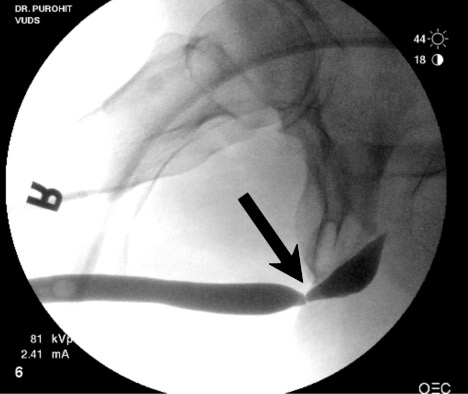 X-ray showing urethral stricture