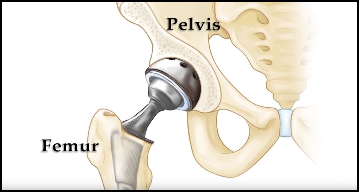 Total Hip Replacement